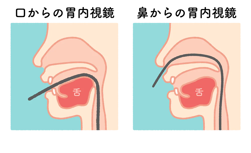 経鼻と経口検査を選べます